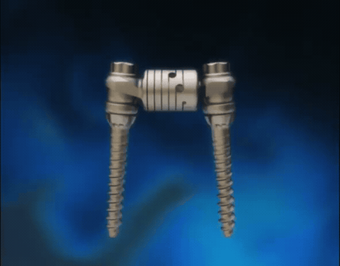 Animated demonstration of the posterior dynamic stabilization device