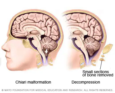 Supplied comparison diagram of Chiari malformation and surgical decompression