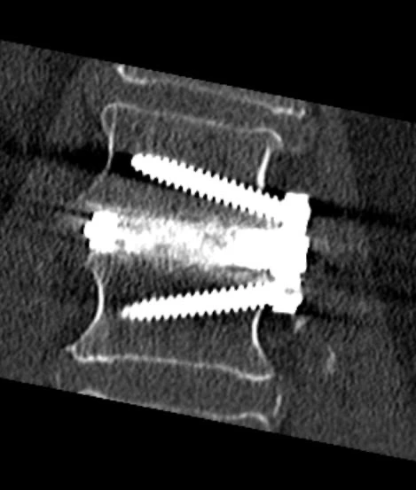 Supplied spinal fusion scan showing adjacent vertebrae with screws and fixation hardware