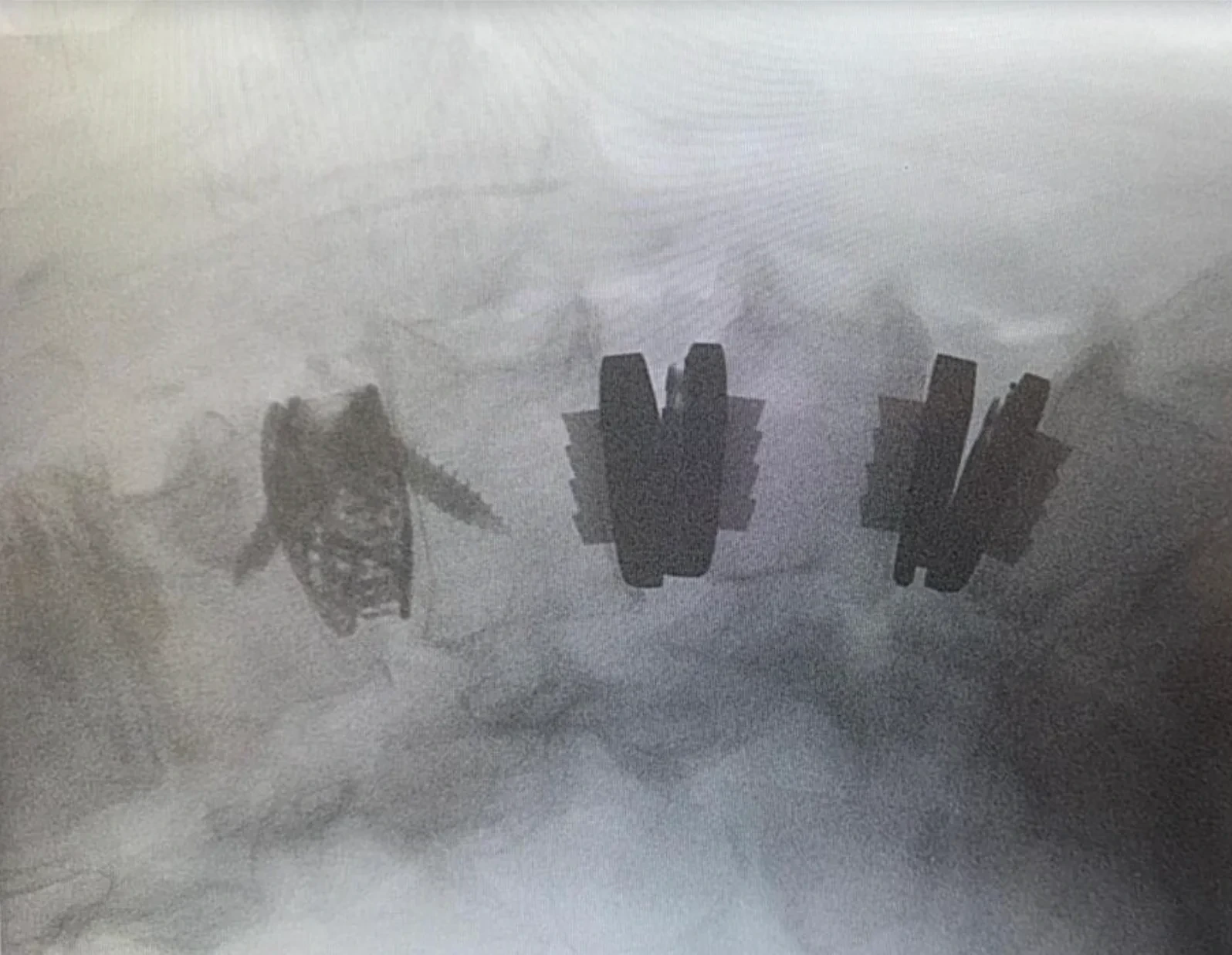 Supplied spinal X-ray showing a hybrid construct with different implants at adjacent levels, rotated clockwise