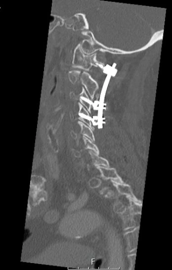 Supplied cervical spinal scan showing screw and rod instrumentation