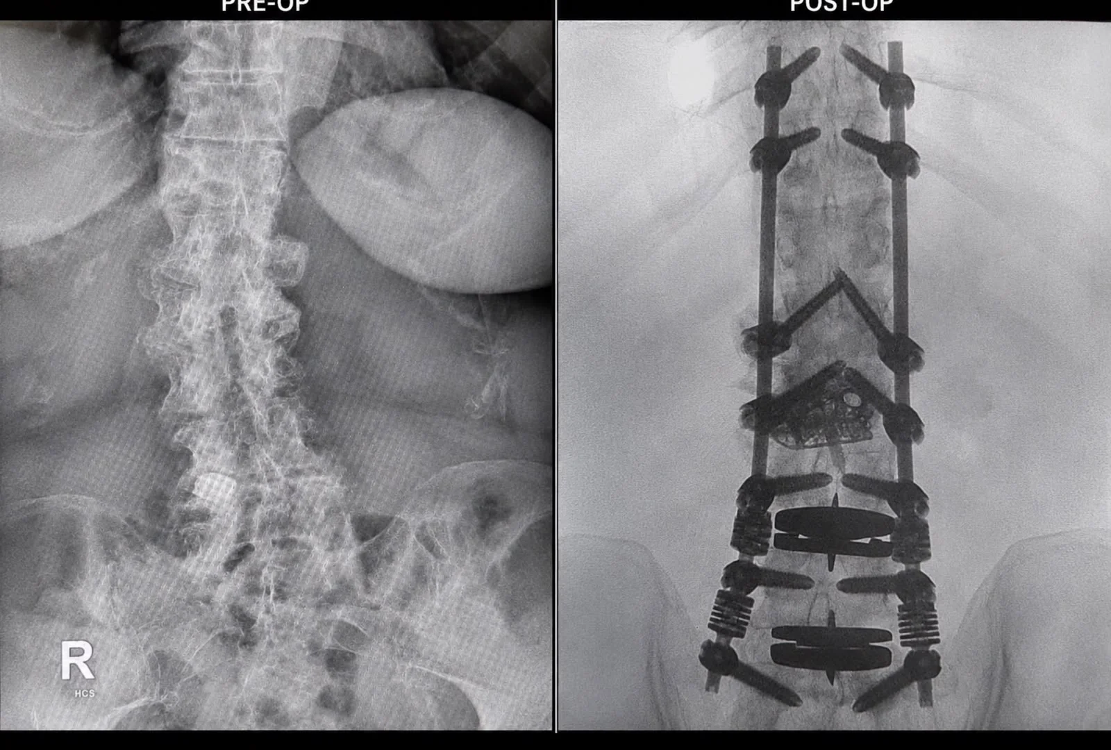 Complete supplied pre-operative and post-operative spinal X-rays for scoliosis and deformity correction