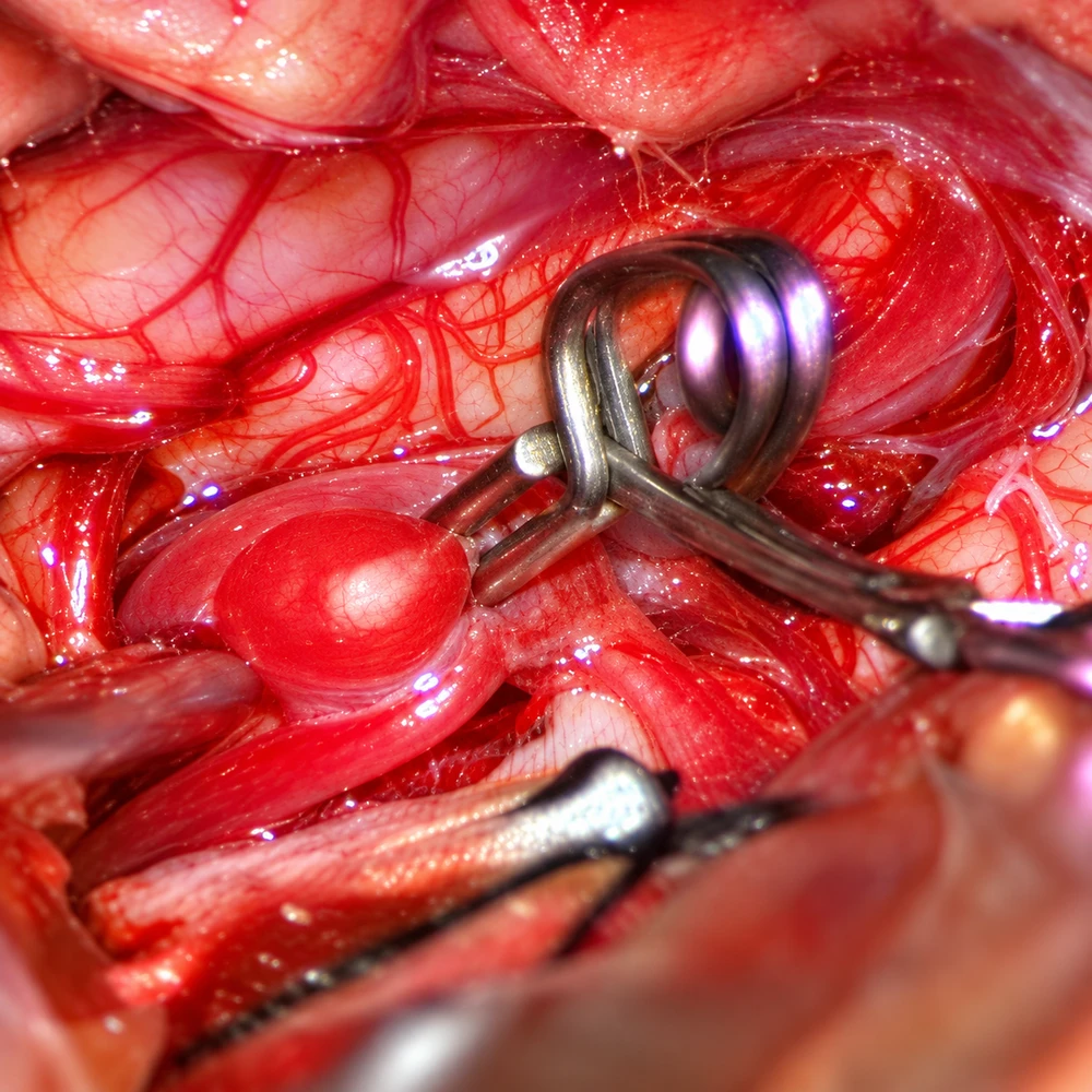 Enhanced reference of the aneurysm after microsurgical clipping
