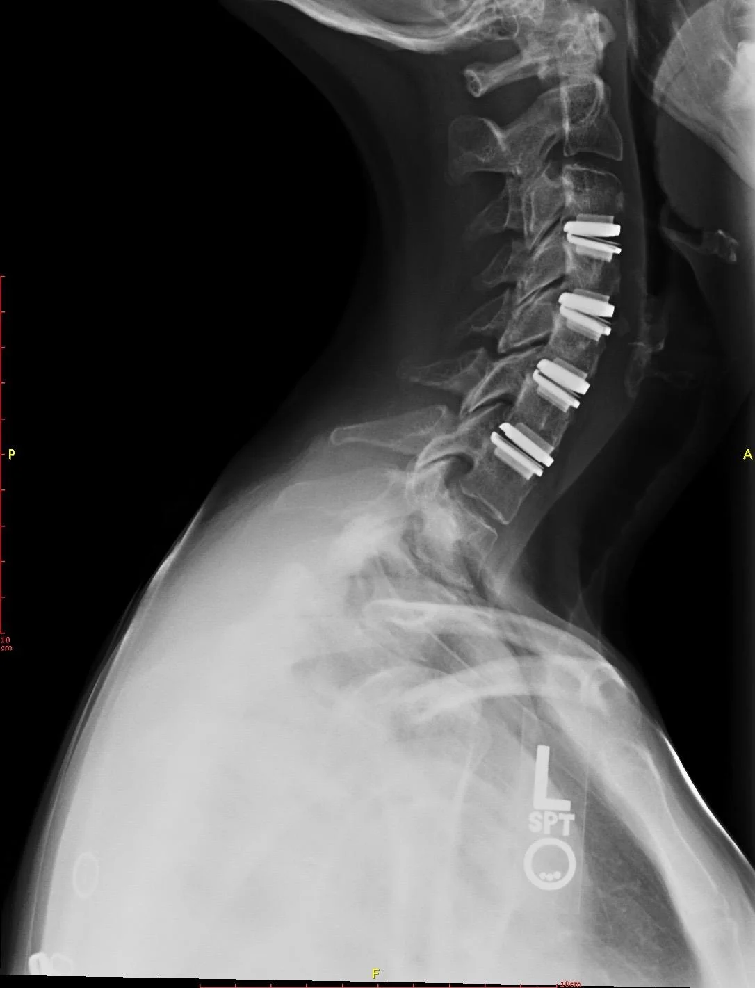 Artificial Disc Replacement