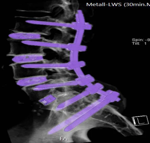 Complex & Revision Spine Surgery