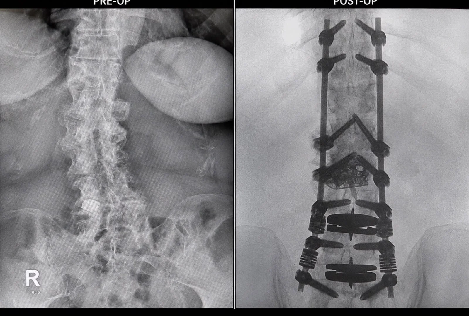 Scoliosis & Deformity Correction